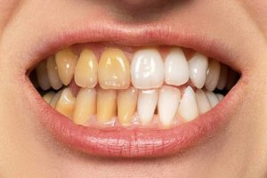How To Whiten Yellow Teeth Quickly Using Photoshop